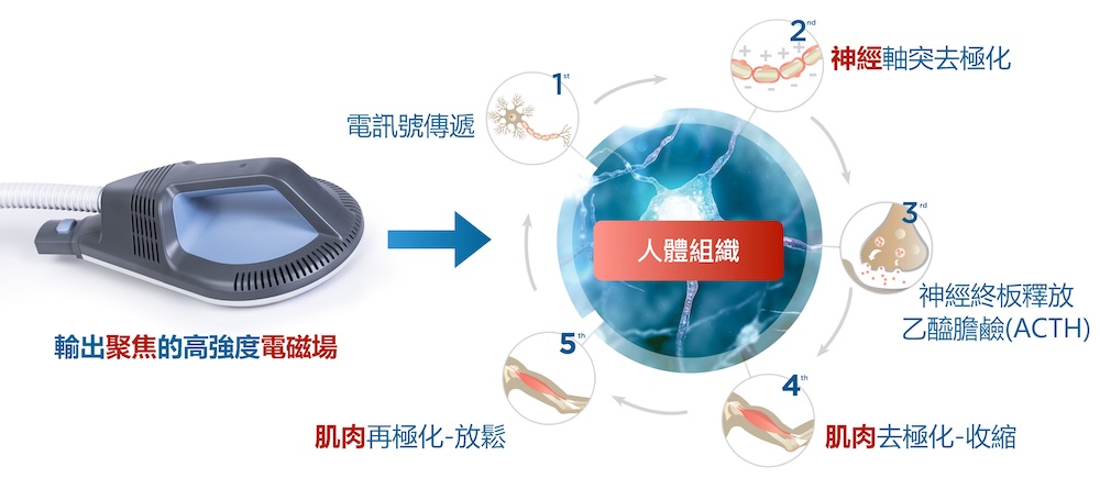 SIS超磁場治療運作原理示意圖，展示高強度聚焦電磁場透過神經與肌肉傳導路徑，促進肌肉放鬆與循環