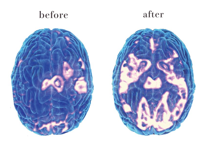 憂鬱症大腦經rTMS 重複經顱磁刺激治療的治療前後對比